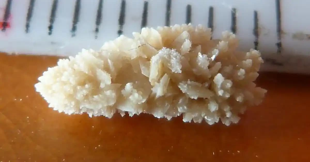 Manyetik Mikro-Robotların Böbrek Taşları Tedavisindeki Rolü ve Mevcut Yöntemlerle İlişkisi