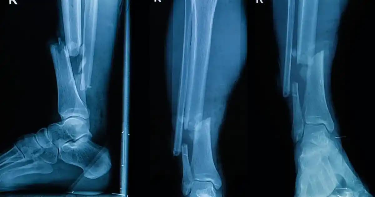 Ameliyatlarda Kırıklara Doğrudan Biyobozunur Kemik Grefti Uygulayan Modifiye Tutkal Tabancası